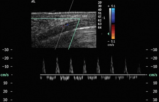 Color Doppler ultrasound  carpal tunnel syndrome {faces}